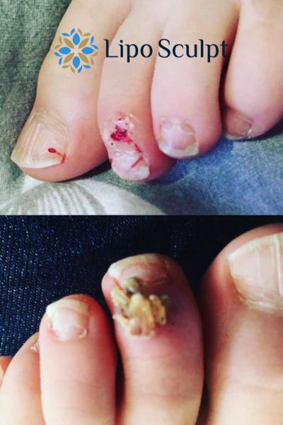 Wart removal customer results from Lipo Sculpt Irvine